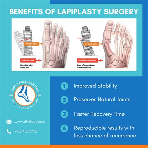 benefits of lapiplasty bunion surgery.